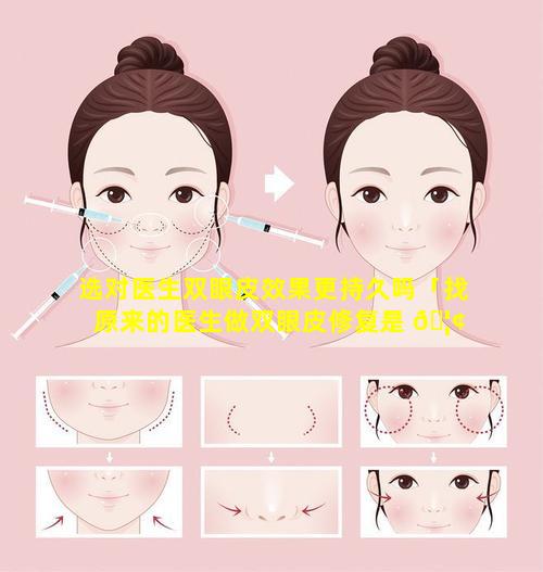 选对医生双眼皮效果更持久吗「找原来的医生做双眼皮修复是 🦢 怎么收费的」